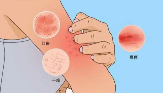 冬季皮肤干痒真是“干”的错吗?(图3)